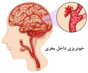 خونريزي داخل مغزي